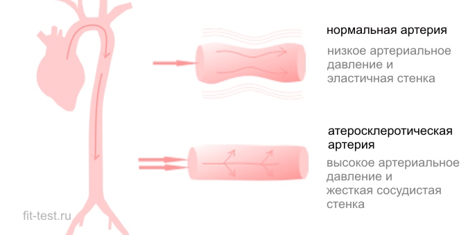 нормальная артерия и с атеросклерозом