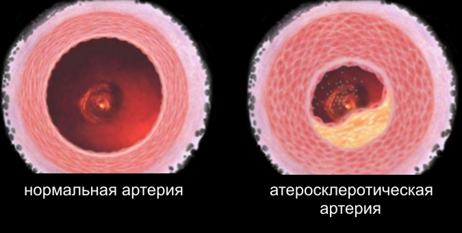 нормальная артерия и с атеросклерозом